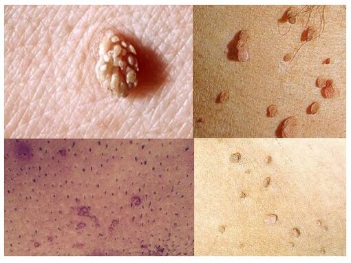 vücutta genital siğiller