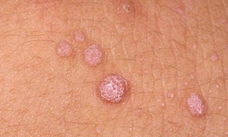 HPV cilt papillomlarının ortaya çıkmasına neden olur