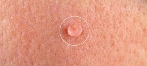 vücutta genital siğiller